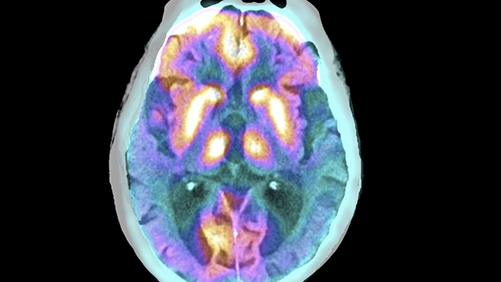 Alzheimertypische Veränderungen im Gehirn werden auf PET-Aufnahmen sichtbar.