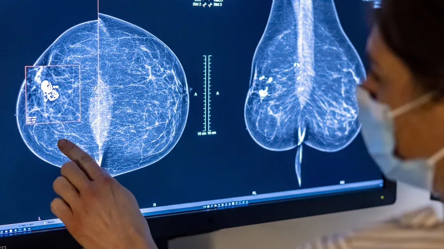 Hier kann KI helfen: Auf Mammografie-Bildern wird nach Brustkrebs gesucht.