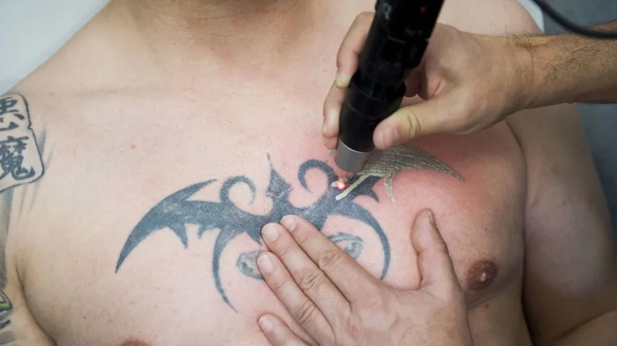 Ein Arzt entfernt in der Universitätsklinik mittels eines Lasers bei einem Mann ein Tattoo auf der Brust.