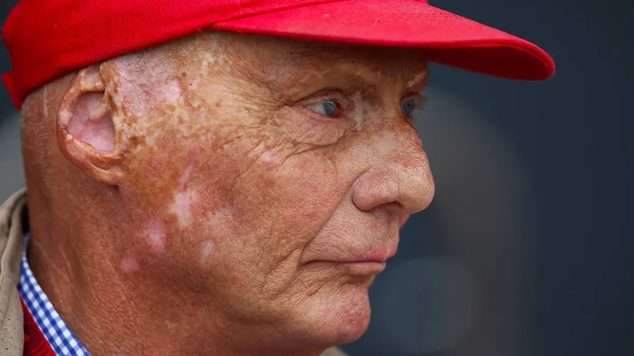 Die Folgen des schweren Unfalls vor 40 Jahren sieht man Niki Lauda bis heute an.