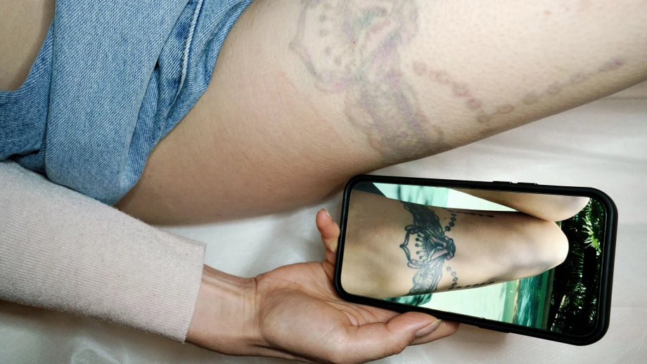 Wenn das Tattoo wieder weg soll