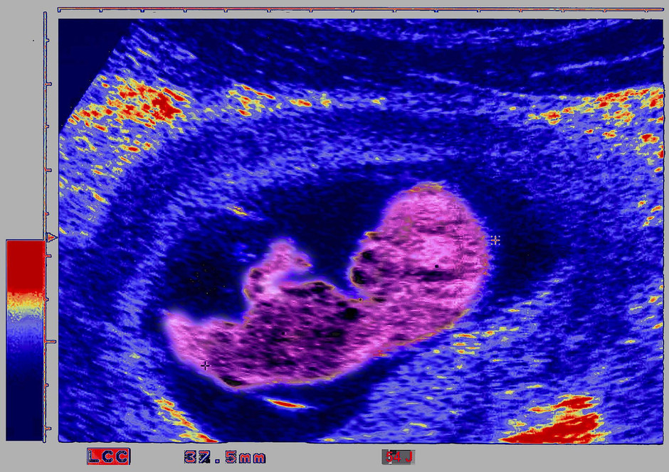 Bild zu: Gefahren von Valproat für ungeborene Kinder - Bild 1 von 1 - FAZ
