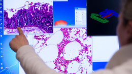 Präzisionstherapie von Dickdarmtumoren