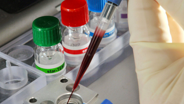 Sepsis - Blutvergiftung als häufigste vermeidbare Todesursache
