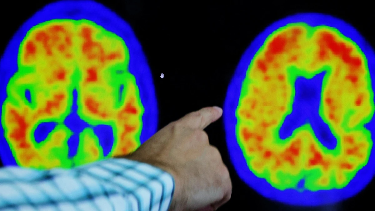 Rückgang der Demenzen: Plötzlich herrscht Optimismus unter Alzheimer-Experten