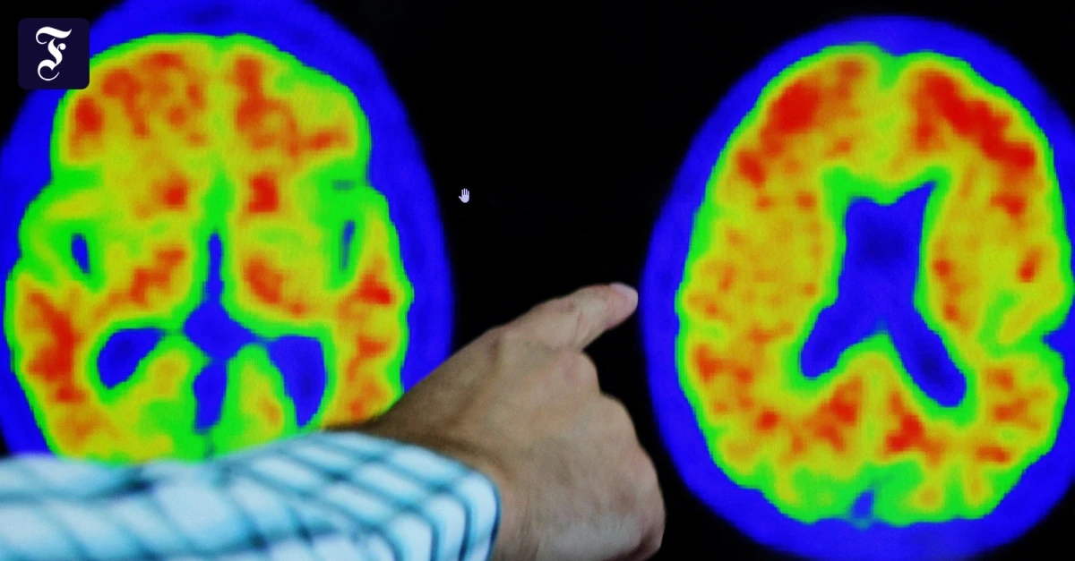 R-ckgang-der-Demenzen-Pl-tzlich-herrscht-Optimismus-unter-Alzheimer-Experten