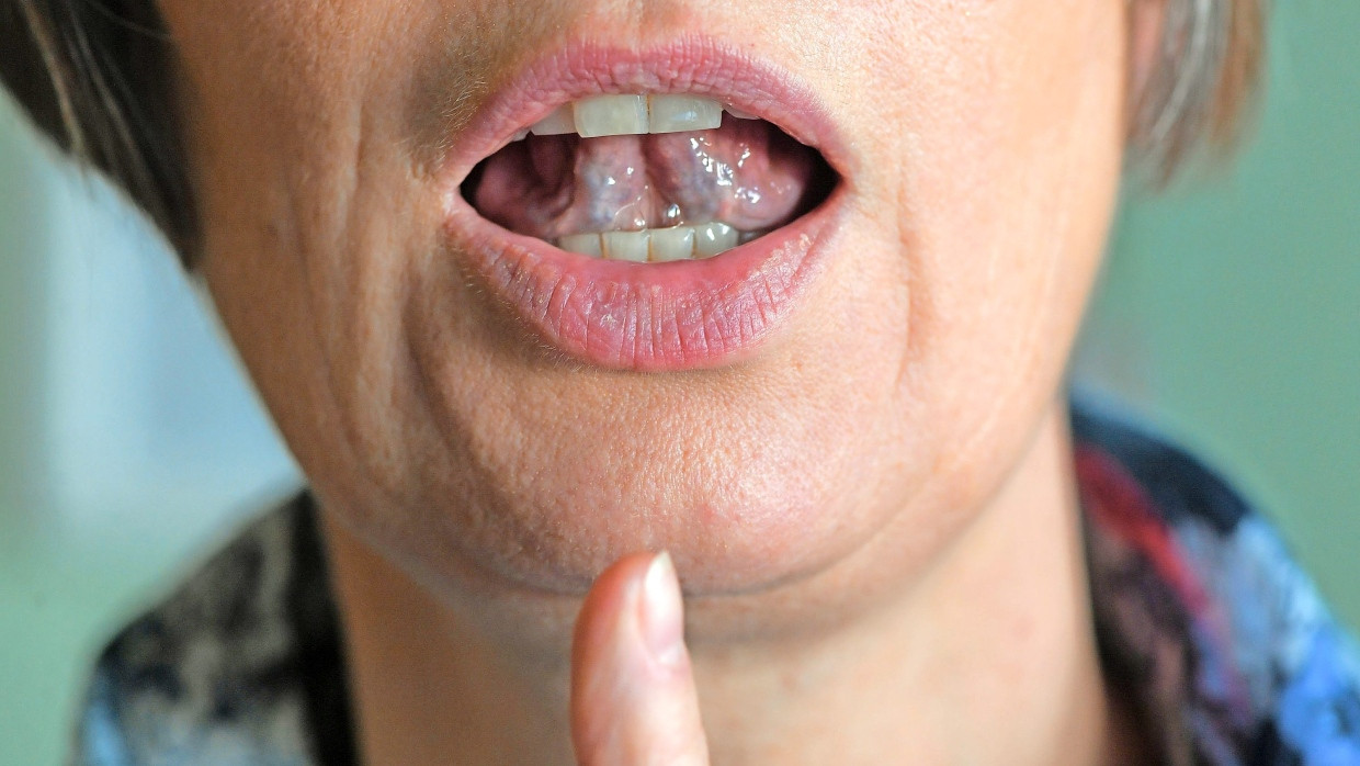 Falscher Zungenschlag: Gegen Stottern können auch logopädische Übungen helfen.