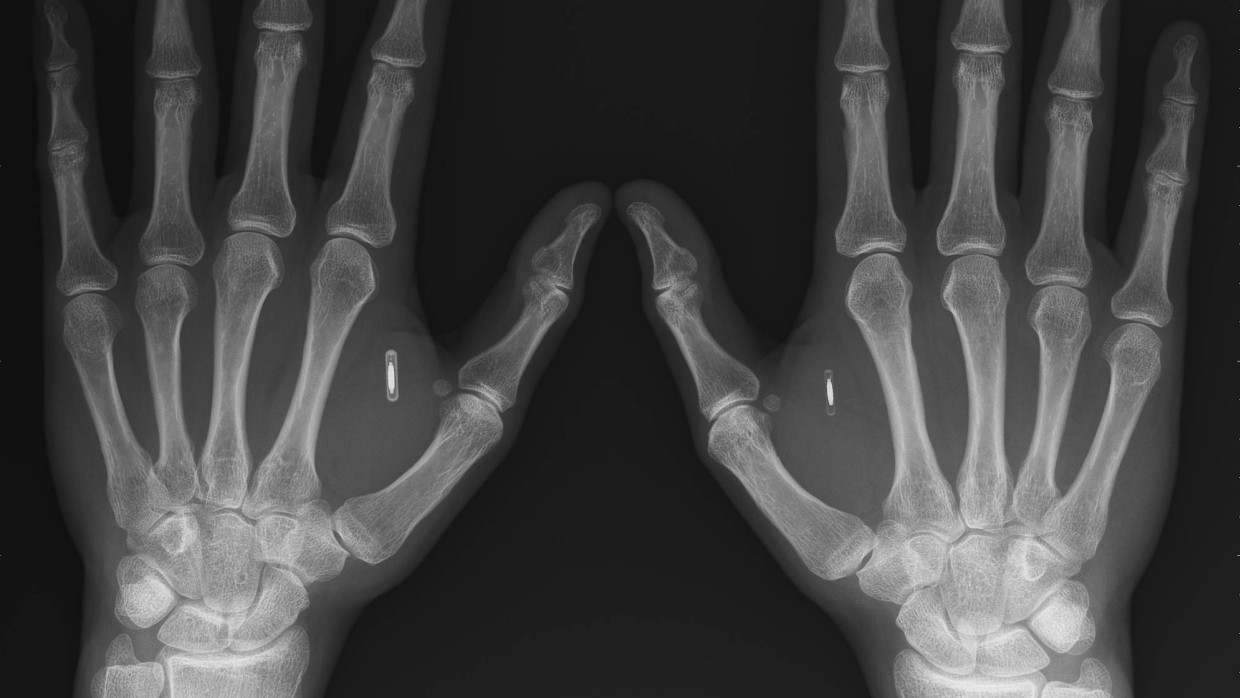 NFC in der Hand: Zwei Implantate,in der Röntgenaufnahme der Hände jeweils zwischen Zeigefinger und Daumen von Aral Graafstra, dessen Unternehmen „Dangerous Things“ solche NFC-Produkte vertreibt.